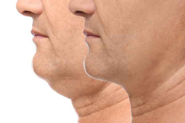 HIFU - Breakthrough in Anti - ageing 2 hifu results Bedford