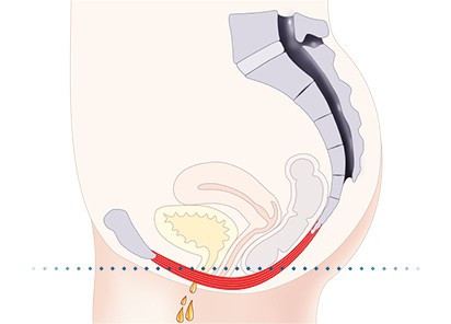 Pelvic-Floor Muscle Repair 5 Pelvic floor muscles Bedford