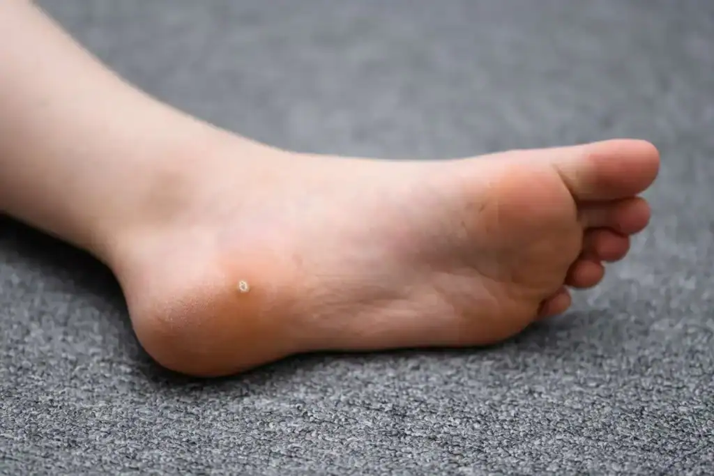 Cryotherapy For Warts And Also Verrucas 2 Image of verruca on the bottom of the foot that able to be treated with Cryotherapy Bedford