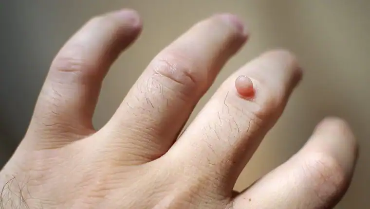 Image of blemish that Cryotherapy Bedford can remove with Lipo 360.