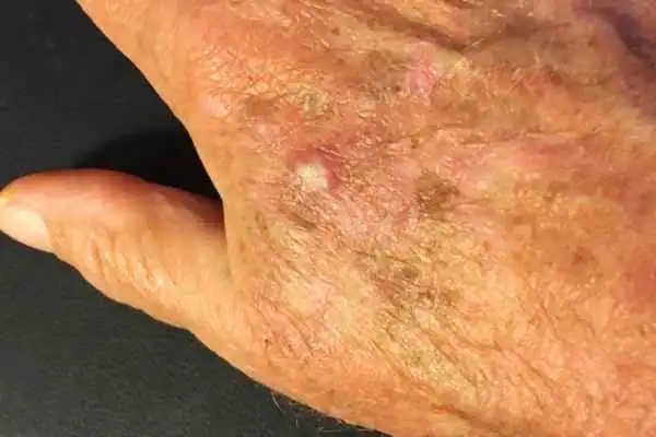 Image of Actinic keratoses Bedford on a person hand