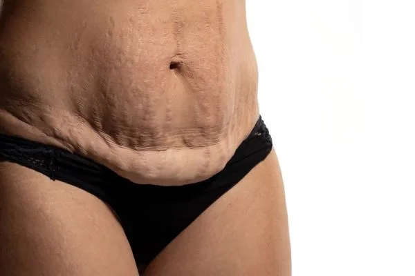 The science behind skin tightening Bedford picture of a woman's sagging skin on the stomach
